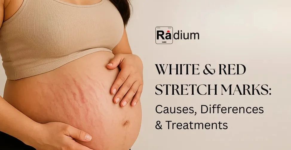 White and Red Stretch Marks