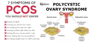Ovaphil F Pcos