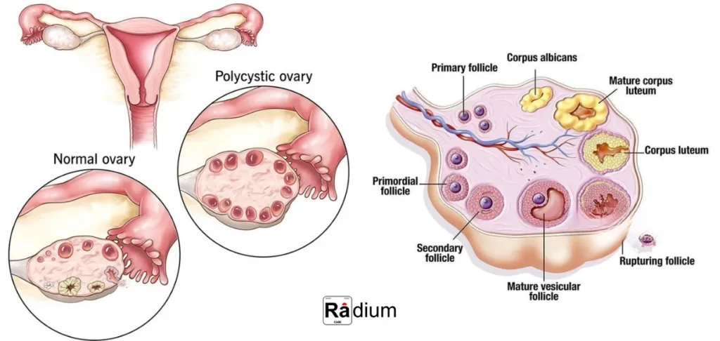 ovaphil l pcos