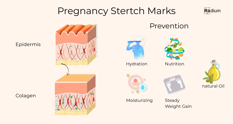 Pregnancy stertch marks