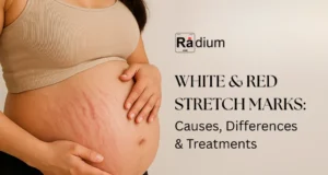 white & red stretch marks