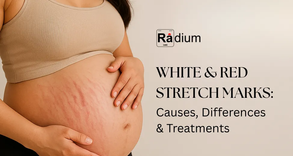 white & red stretch marks